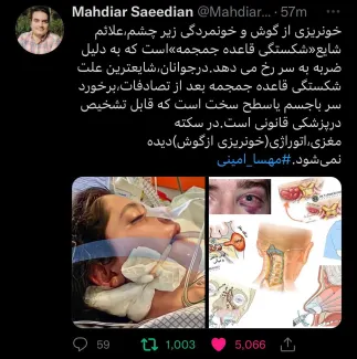 خون‌ریزی از گوش و خون‌مردگی زیر چشم‌، علائم شایع «شکستگی قاعده جمجمه» است که به دلیل ضربه به سر رخ می دهد.