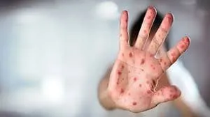 مرکز بهداشت جنوب تهران دانشگاه علوم‌ پزشکی: ۶۷۴ مورد ابتلا به سرخک طی سال گذشته گزارش شده که چهار نفر از آن‌ها در تهران بودند.